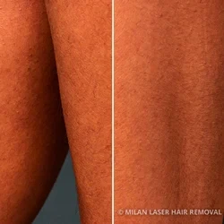 Skin Renewal Price List | Laser Hair Removal Solutions